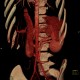 Retroaortic renal vein, duplication of renal vein, VRT: CT - Computed tomography